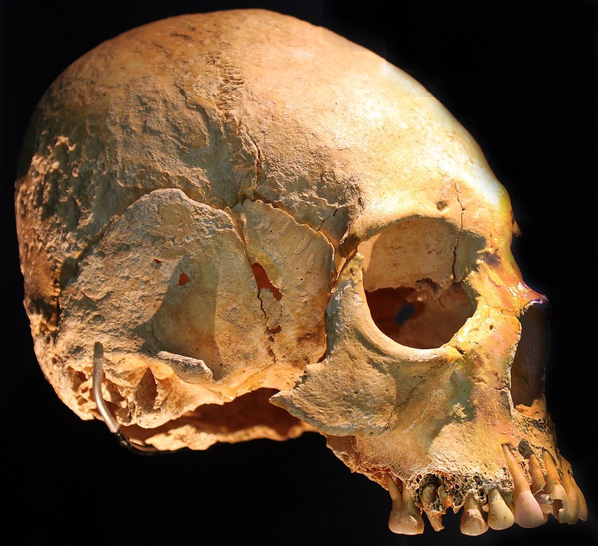 A skull with a lengthened braincase in a European museum collection